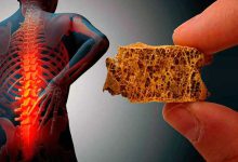 تندرستی علائم پوکی استخوان