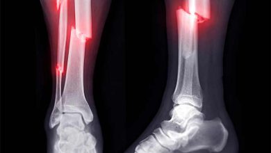 شکستگی استخوان