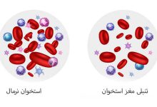 تنبلی مغز استخوان تنبلی مغز استخوان