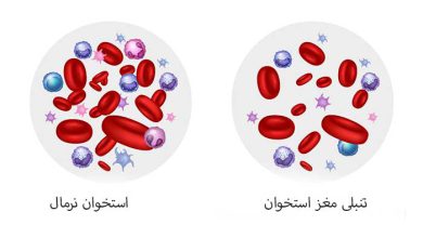 تنبلی مغز استخوان
