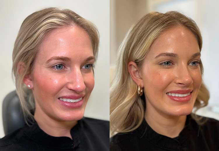 لیفت پیشانی