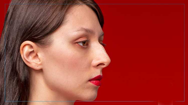 بینی استخوانی